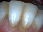 Tartar causing gum destruction on lower gums