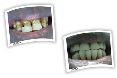 Teeth discolored and decayed due to fluorosis