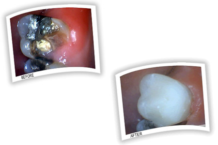 Tooth decay on a tooth with an old amalgam filling