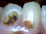 Cavities on 2 lower front teeth