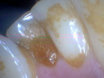 Tartar on lower teeth