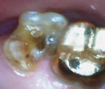 Extensive tooth decay