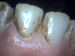 Nicotine stains lower teeth