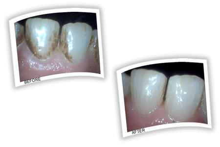 Nicotine stains lower teeth