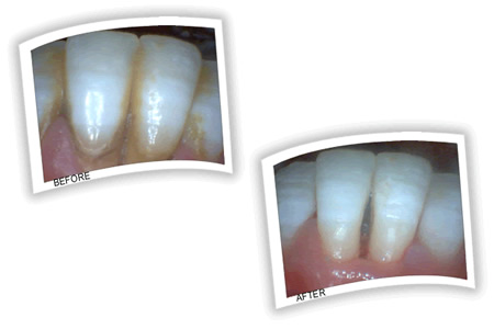 Tartar causing gum destruction on lower gums
