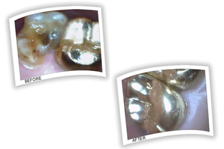 Extensive tooth yecay