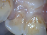 Tooth Cavity