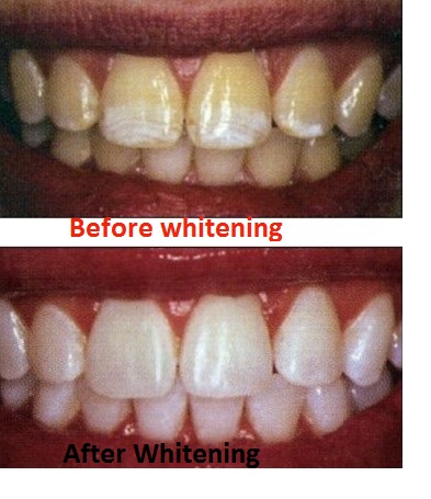 Tooth cavity on a front upper tooth