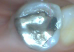 Old amalgam filling