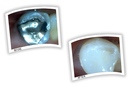Old amalgam filling