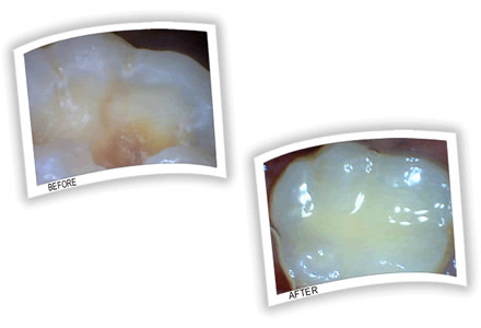 Cavity on a molar tooth