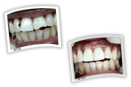 Cavity on tooth upper 2nd left and chipped tooth upper 3rd right