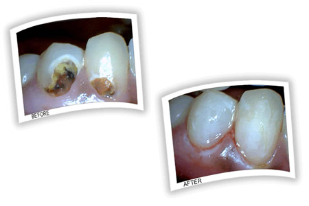 Cavities on 2 lower front teeth