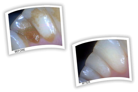 Tartar on lower teeth