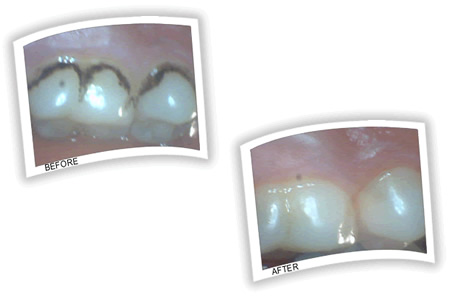 Stains on back teeth